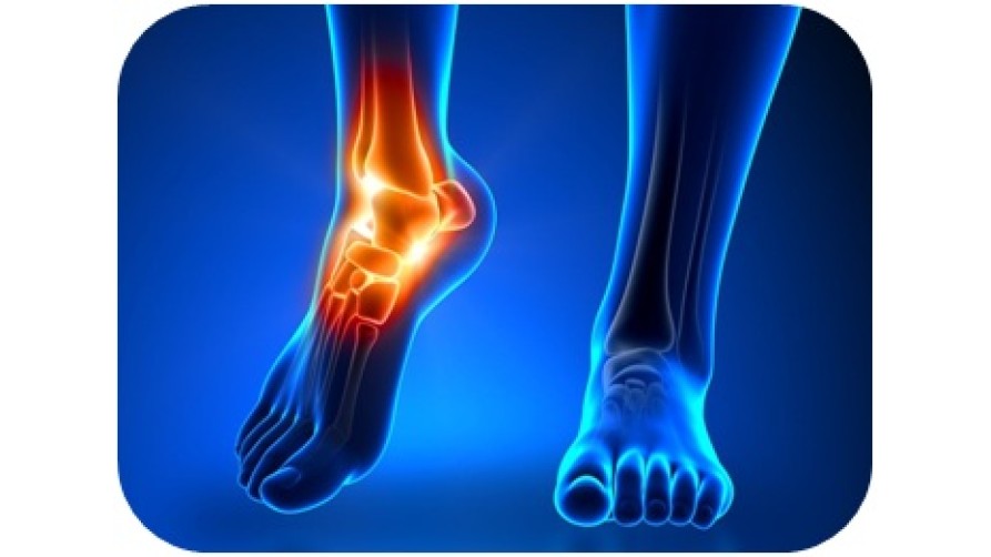 ANKLE SPRAIN IN SPORTS